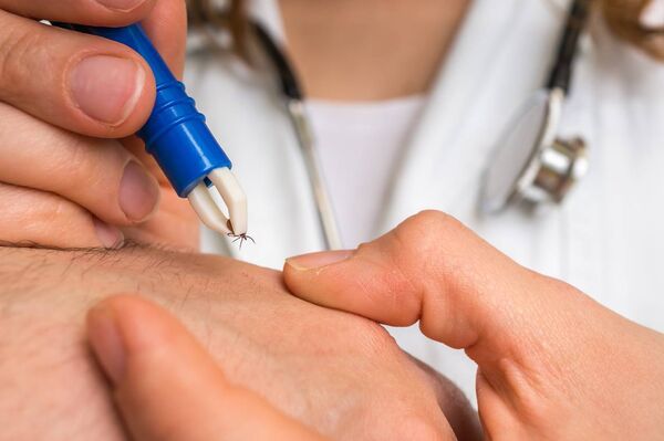 Doctor removes a tick with tweezers from hand of patient. Doctor removes a tick with tweezers from hand of patient.